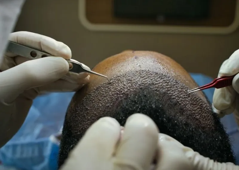 Hair Transplant Hospitals and Clinics