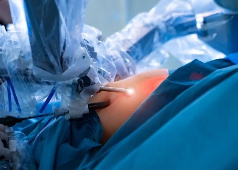 Surgical team performing a laparoscopic weight loss procedure in a modern operating room