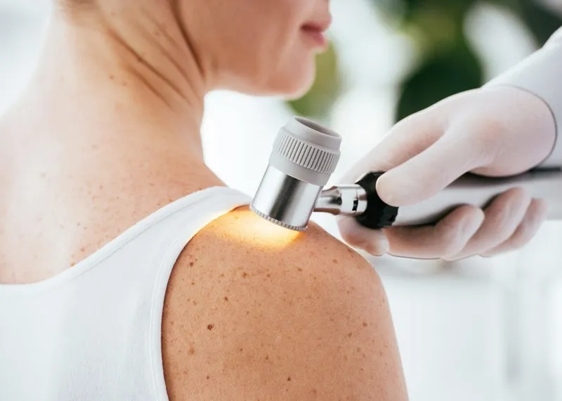 Dermatologist inspecting a skin lesion with a dermatoscope before a biopsy