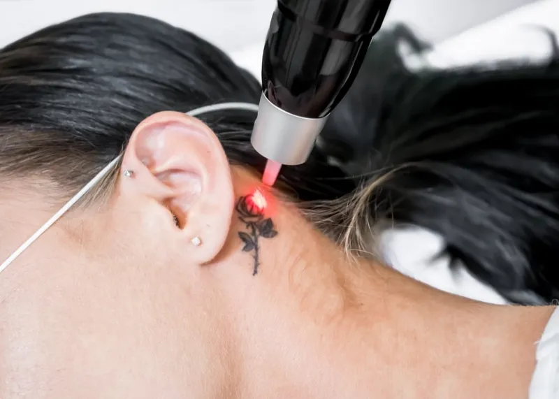 Patient wearing protective eyewear while receiving facial laser therapy